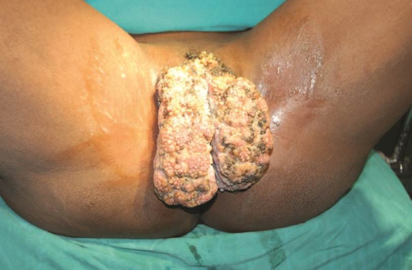 condylomata acuminata and human genital cancer