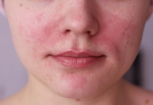 CBD Oel fuer Rosacea