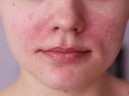 CBD Oel fuer Rosacea